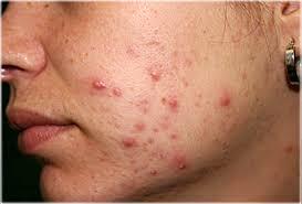 Pimple (Acne) Care of your Face